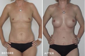 breast augmentation before and after - patient 001 - mummy makeover - front view