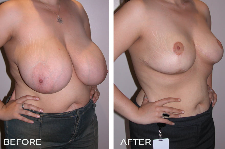 Large Breast Surgery - Breast Reduction Surgery Image 