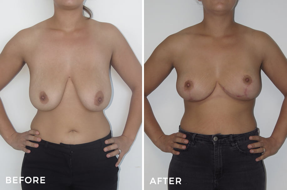 breast reduction - before & afters image - patient 019 - front view