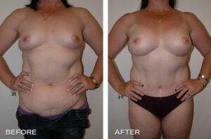 recovery after tummy tuck