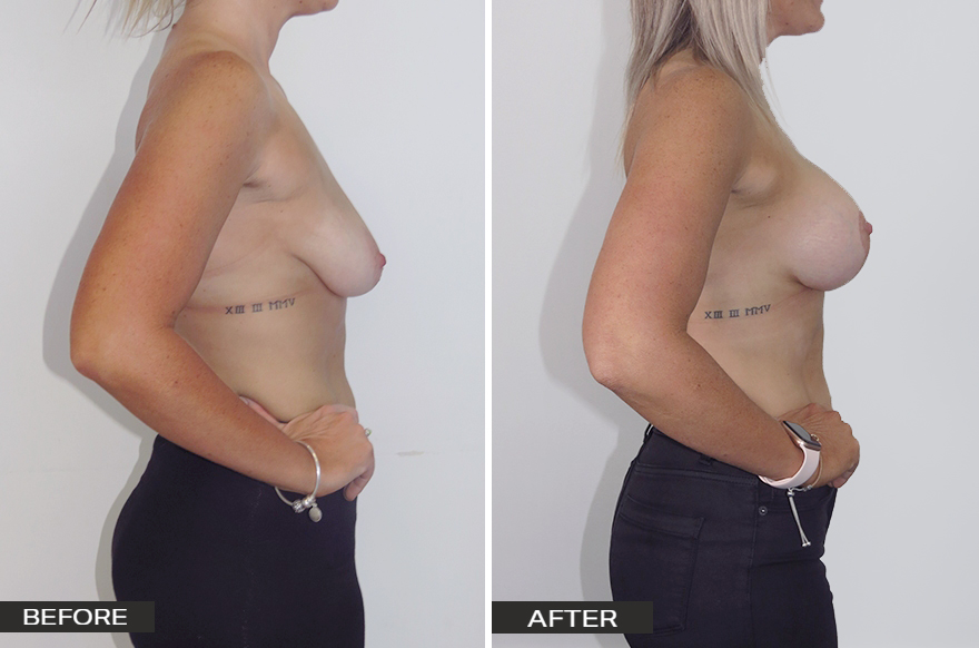 Breast Lift with Implants Patient Before and After Image Side