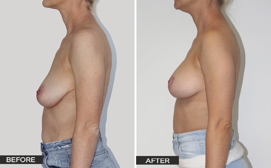 Case Study Saggy Breasts - Dr Hunt