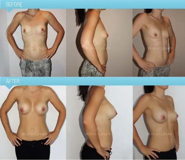 Dr Jeremy Hunt - Case Study Bilateral Breast Augmentation Scaled