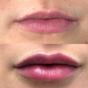tear trough filler sydney - lip enhancement Dr Jeremy Hunt top Plastic surgeon NSW