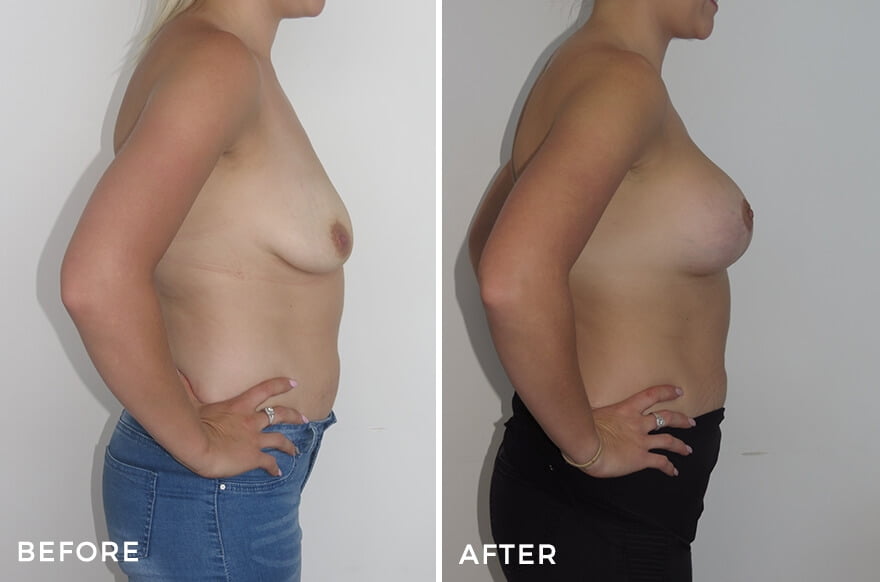 Breast Lift Sydney Dr Jeremy Hunt Before and After Photo - LIFT 11 Side
