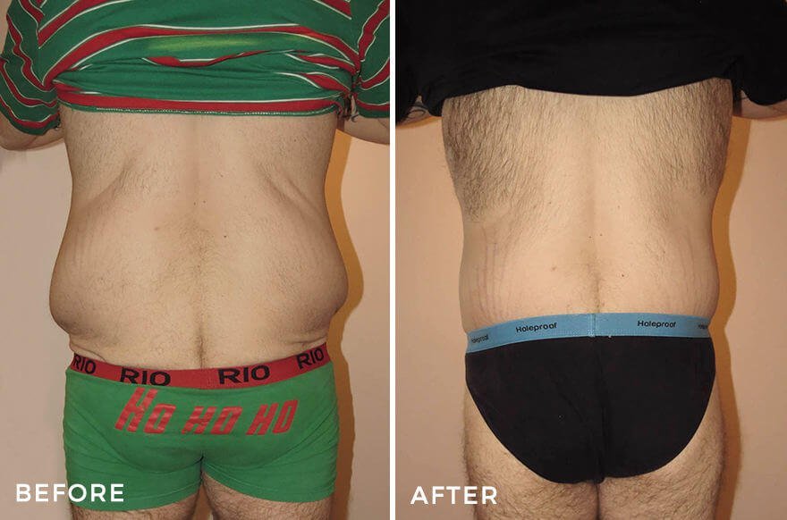 Tummy Tuck + Liposuction - Male Body Contouring Before and After