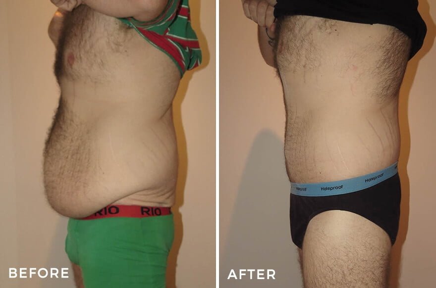Tummy Tuck + Liposuction - Male Body Contouring Before and After