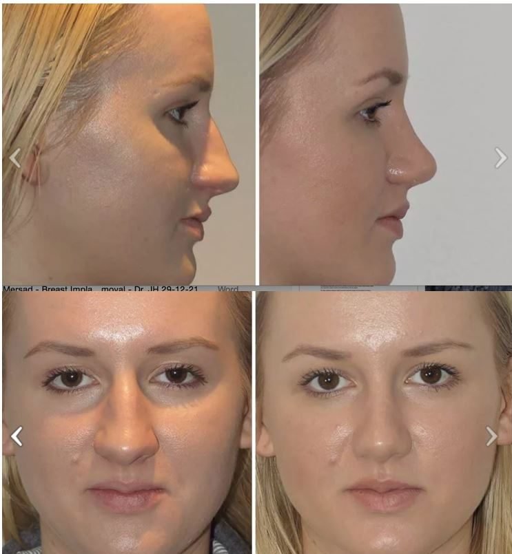 different Types of Noses - refinement rhinoplasty - Dr Jeremy Hunt Leading face surgeon