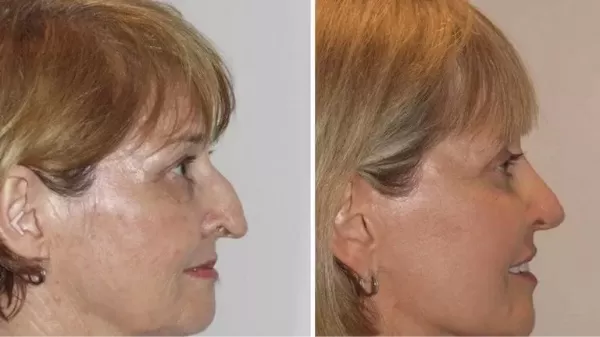 hawk nose types sydney - Dr Jeremy Hunt Leading face surgeon