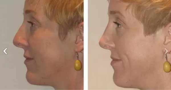 australia different types of noses sydney - greek nose - Dr Jeremy Hunt Leading face surgeon