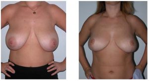 internal bra - How is it performed - Dr Hunt