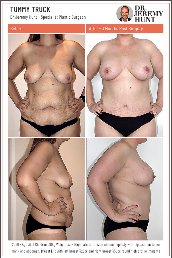 before-and-after-tummy-tuck-abdominoplasty_Dr-Jeremy-Hunt_Top-plastic-surgeon_Sydney