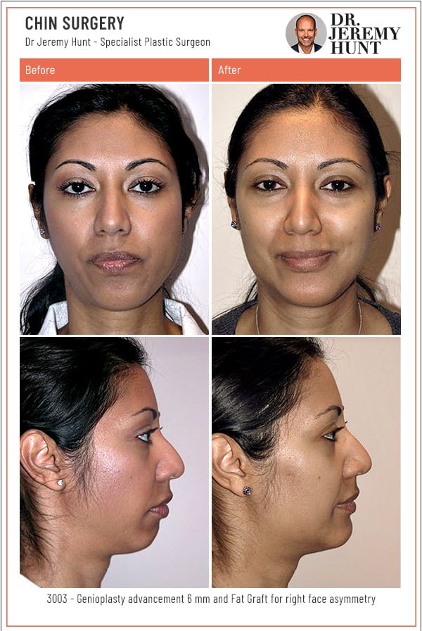 Chin Augmentation Sydney Surgery Before-and-After_Chin-Surgery_Dr-Jeremy-Hunt_Top-Plastic-Surgeon_Sydney