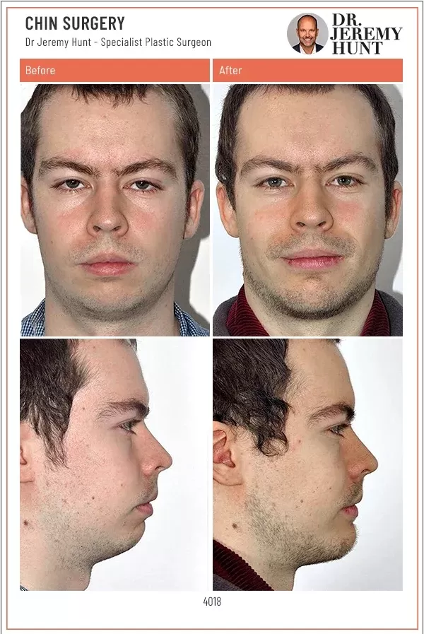 male chin augmentation surgery - genioplasty before and after dr jeremy hunt