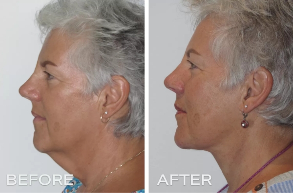 What is neck lift or lower facelift - Dr Jeremy Hunt Leading Plastic Surgeon Sydney NSW