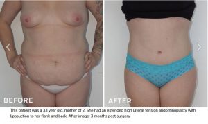 Tummy Tuck Surgery Before and After Dr Hunt