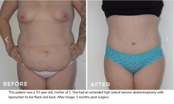 How to Reduce Your Scar After Abdominoplasty Surgery 2 Tummy Tuck Surgery Before and After Dr Hunt