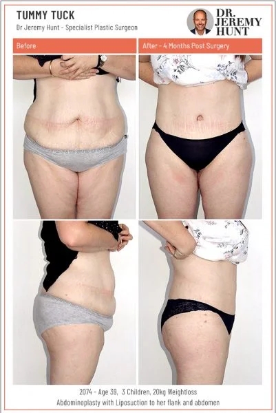 Wearing a Compression Garment after Abdominoplasty 2 2074 tummy tuck sydney dr jeremy hunt