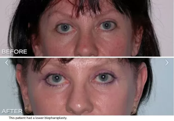 Fat Pads under the Eyes – Nasojugal Fat Pads 1 alt=