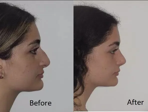 Nasal Dorsum Surgery – Rhinoplasty to Correct the Nose Bridge 2 Dorsal Hump Reduction Nasal Dorsum Surgery – Rhinoplasty to Correct the Nose Bridge - 2