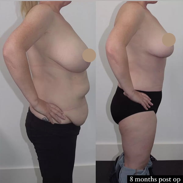 Breast Reduction Before and After Photos - Dr Jeremy Hunt Extended High Lateral Tension Abdominoplasty, a Breast Reduction & a Necklift
