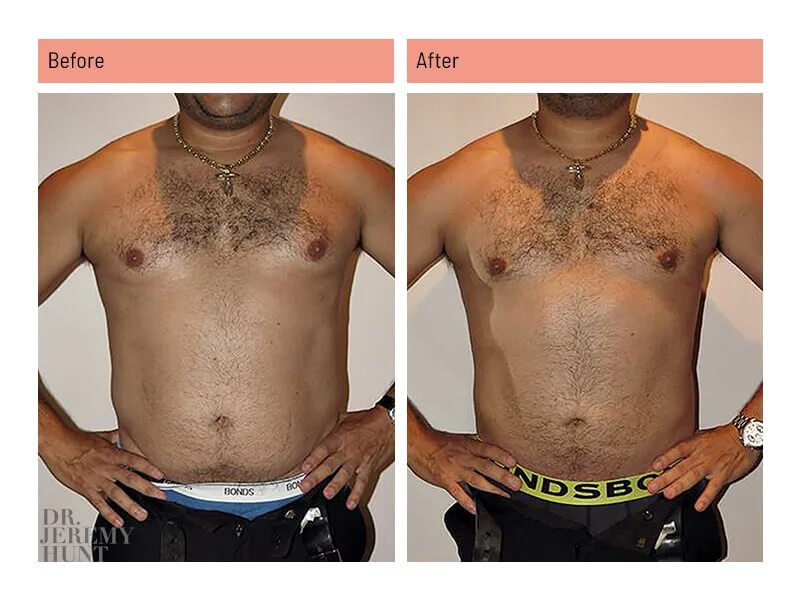 https://www.drjeremyhunt.com.au/wp-content/uploads/2023/09/4010_front_male-liposuction_dr-jeremy-hunt07.jpg