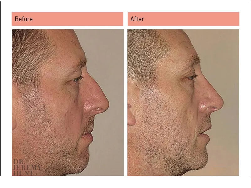 https://www.drjeremyhunt.com.au/wp-content/uploads/2023/09/4030_side_male-nose-surgery_dr-jeremy-hunt15.jpg