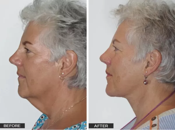 Patient 8 necklift Surgical and Non-Surgical Solutions for Excess Neck Skin - 2
