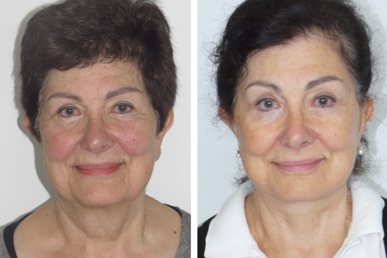 Deep plane facelift in Sydney, before and after, female patient, Dr Hunt, front view, 2148 @2x