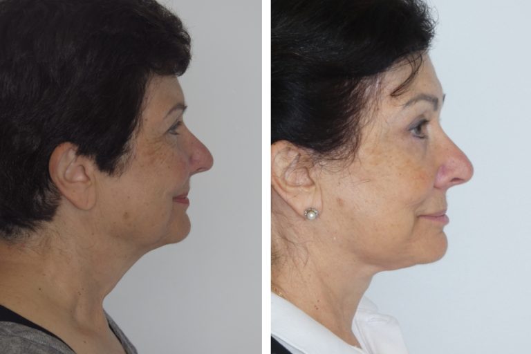 Deep plane facelift in Sydney, before and after, female patient, Dr Hunt, side view, 2148 @2x