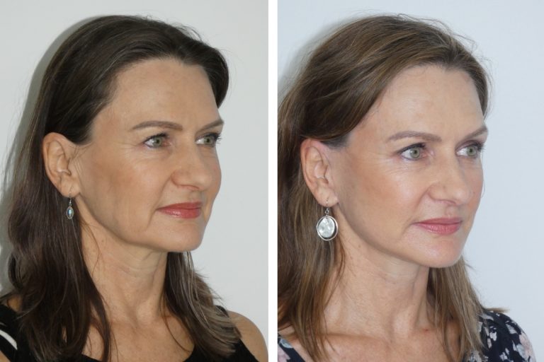 Deep plane face lift (female), before and after, angle view, Dr Hunt Plastic Surgery Sydney, 2171 @2x